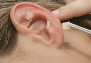 acupuntura-auricular